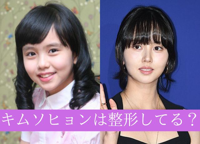 キムソヒョンは整形しているの?