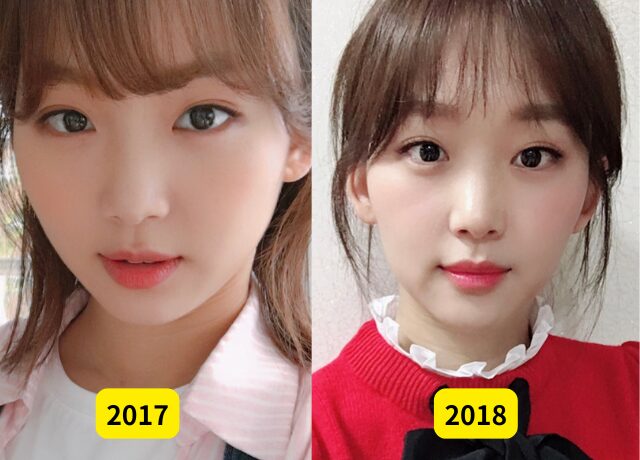 チンギジュの整形検証画像