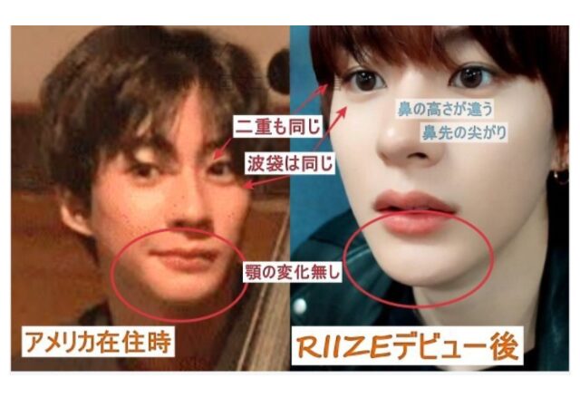 RIIZEアントン整形検証画像