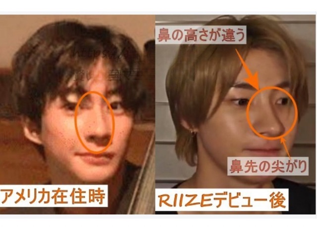 RIIZEアントン整形検証画像